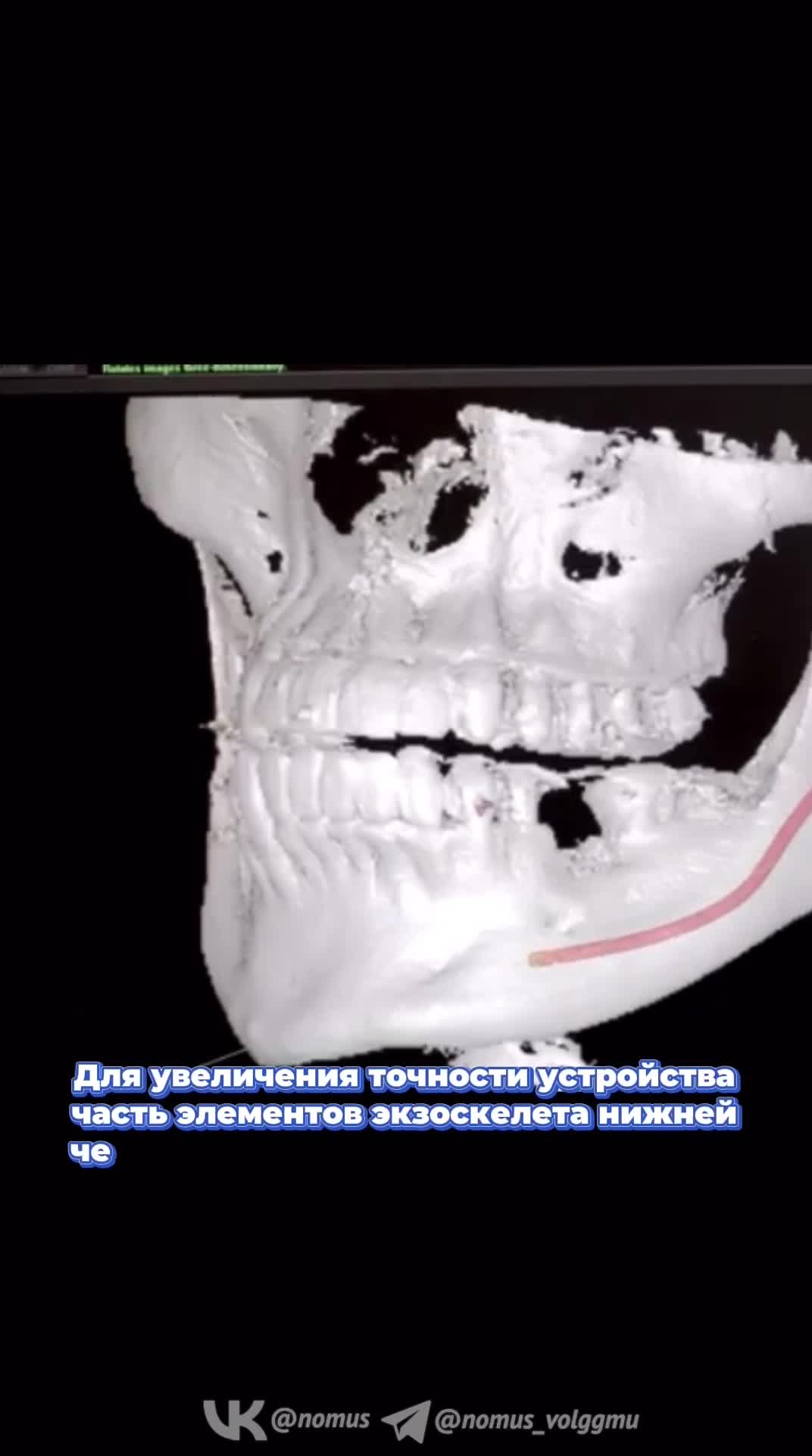 В Волгограде разработали уникальный экзоскелет для раненых с переломами  нижней челюсти - 12 мая 2023 - V1.ру